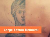 The Tattoo Removal Experts image 3